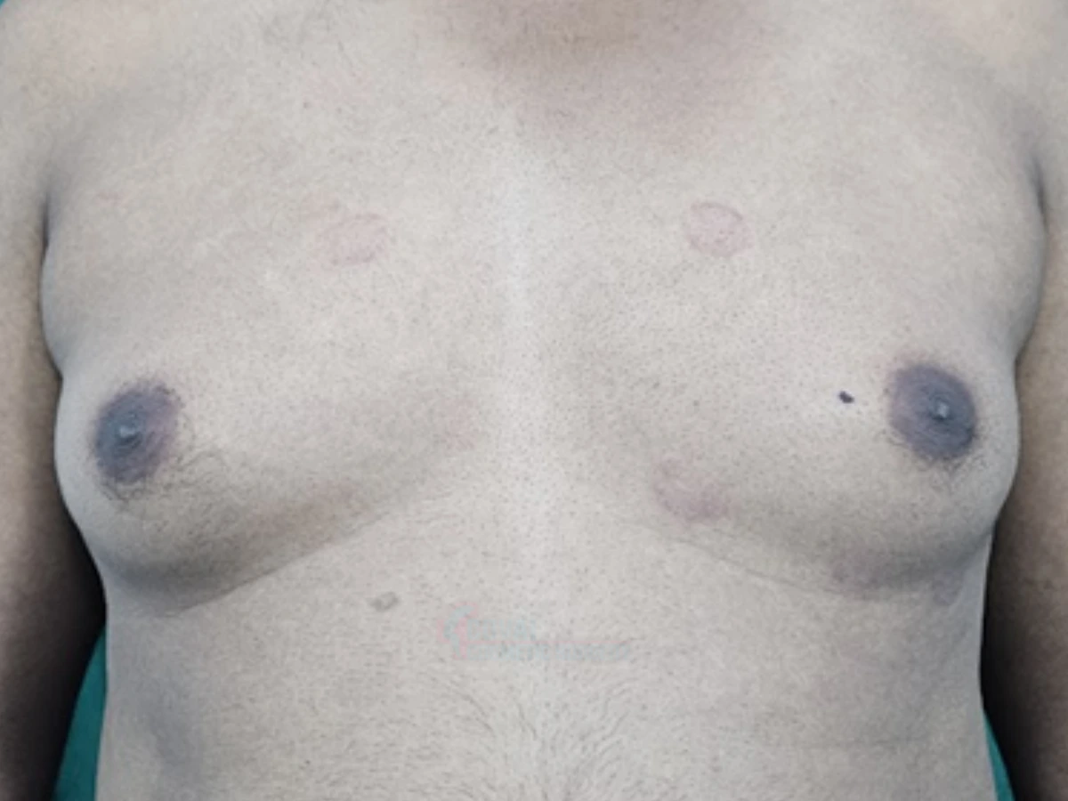 Before - Adipomastia